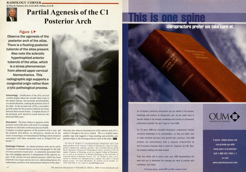 Partial Agenesis of the C1 Posterior Arch