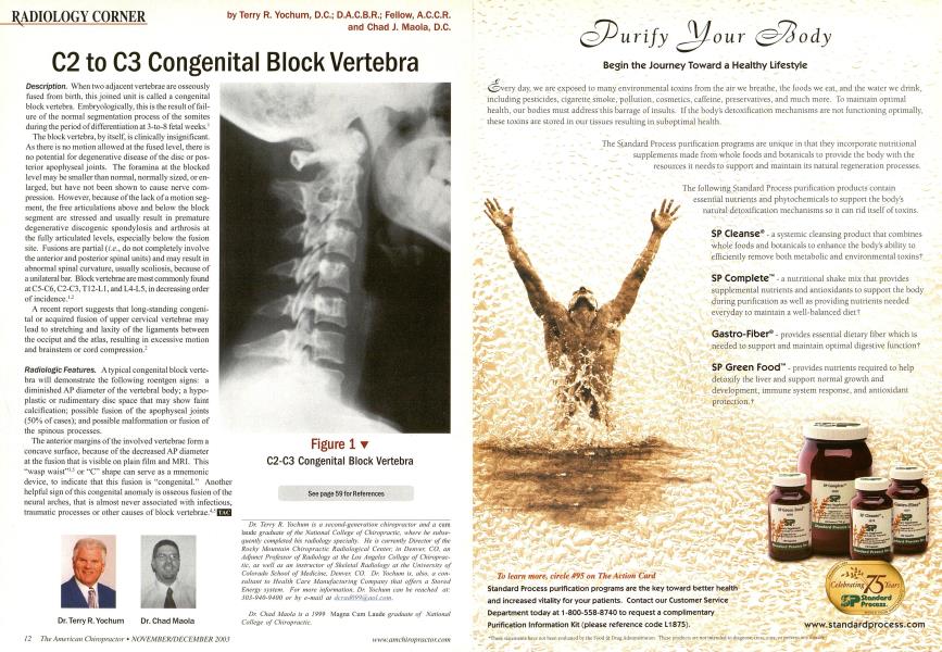 C2 to C3 Congenital Block Vertebra