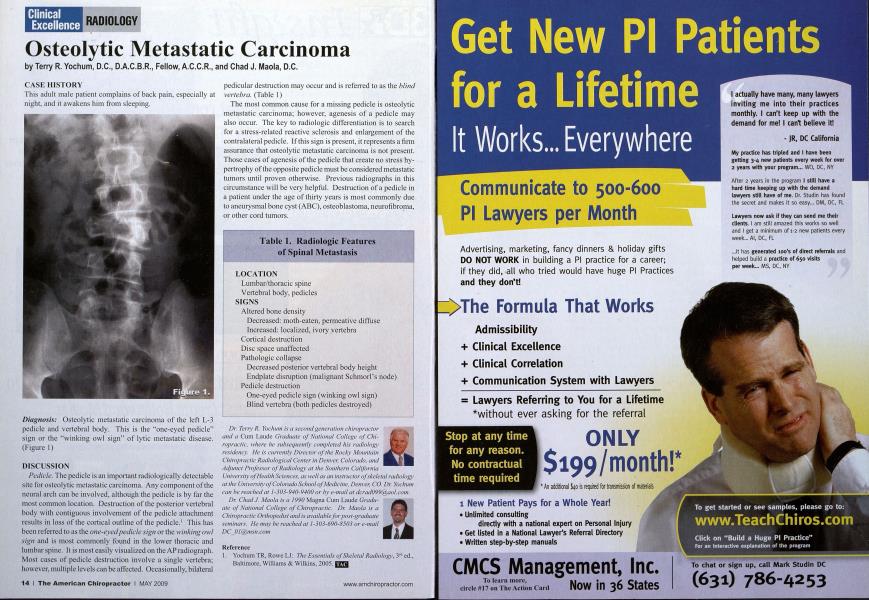 Osteolytic Metastatic Carcinoma