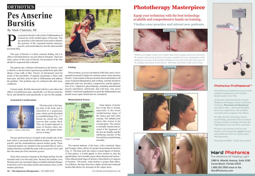 Pes Anserine Bursitis